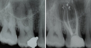 Vyplachování zahnutých kanálků