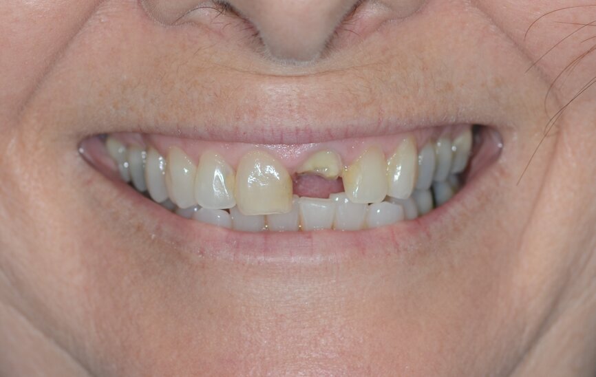 Fig. 1: Initial situation, extra-oral view.