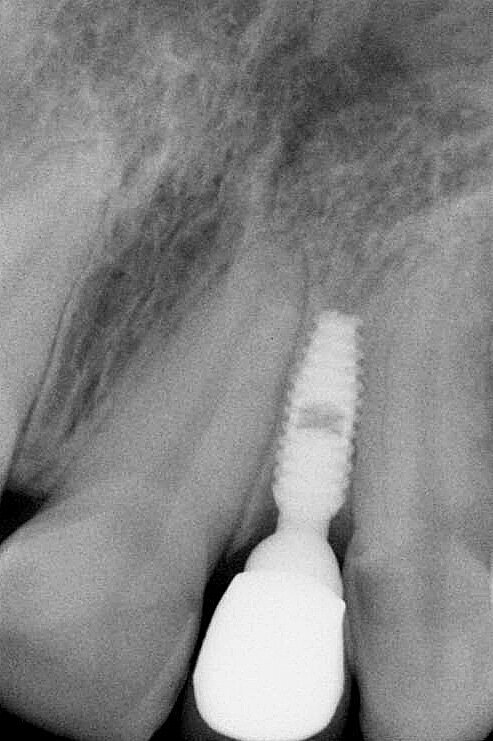 Fig. 8 : Radiographie de contrôle finale trois ans après la mise en fonction. Il faut noter le design de platform-switching entre le col de l’implant et la base hémisphérique du pilier.
