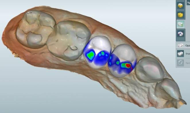 Fig. 6: Software proposal of crowns