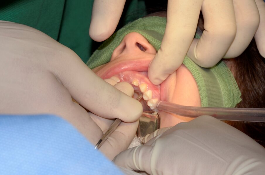 Fig. 6. Raising a palatal mucoperiosteal flap