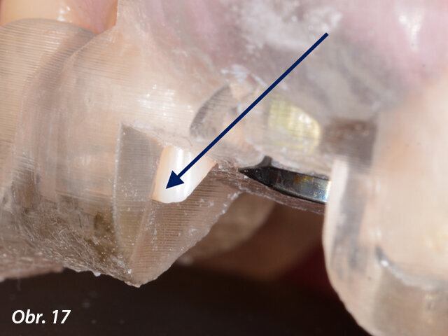 Viditelná přesnost dosedu chirurgické šablony k zubním tkáním (šipka).