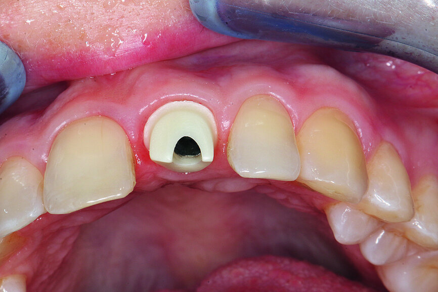 Fig. 17: Complete preservation of the vestibular contour.