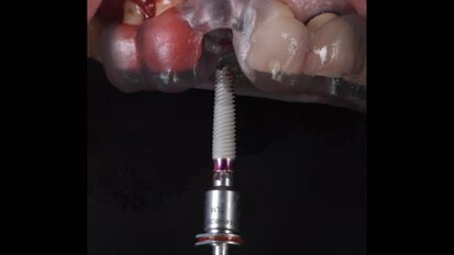 Workflow digitale nella protesizzazione immediata di un impianto abutment free