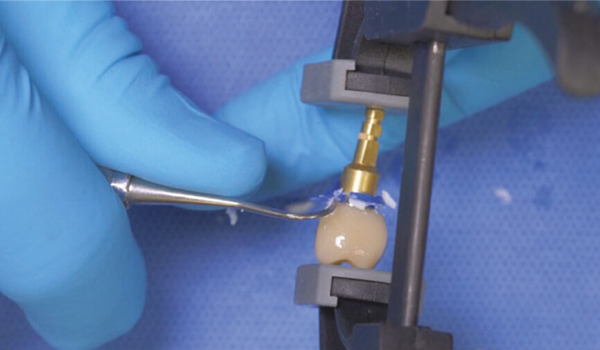 Fig. 12: Remove the excess cement and block-out resin with an explorer—PANAVIA SA Cement Universal is extremely easy to clean up. 