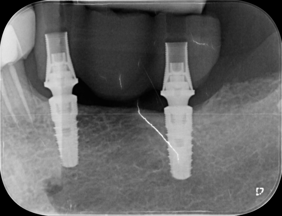 Fig. 12: Bridge in position on the implants, demonstrating seamless integration with the peri-implant bone.
