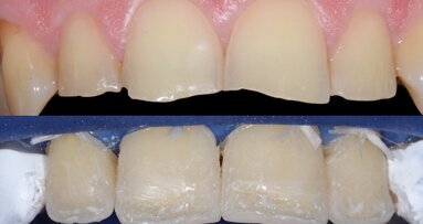 So gelingt die Bisshebung mit direkter Adhäsivtechnik