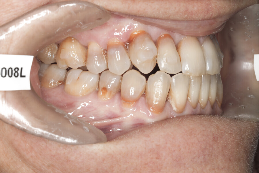 Fig. 46: Situation after 37 Reveal aligners. Case ready for the first refinement. Major change to the patient’s profile.