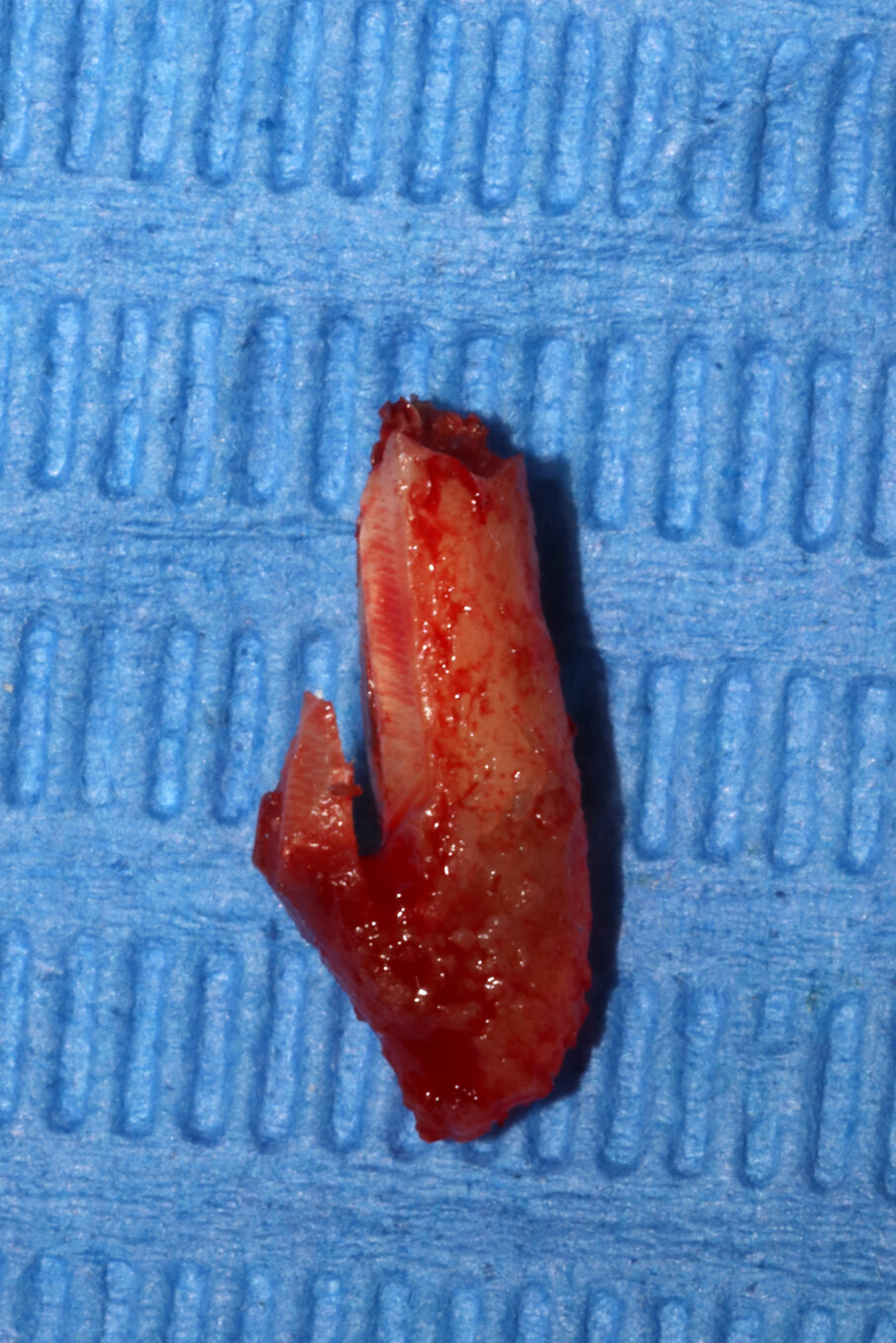 Fig. 12_La porzione di radice linguale correttamente asportata compresa di apice radicolare.