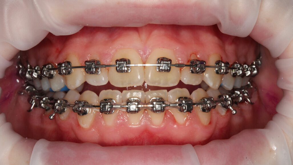 Pacientul ortodontic – Din iad în rai.