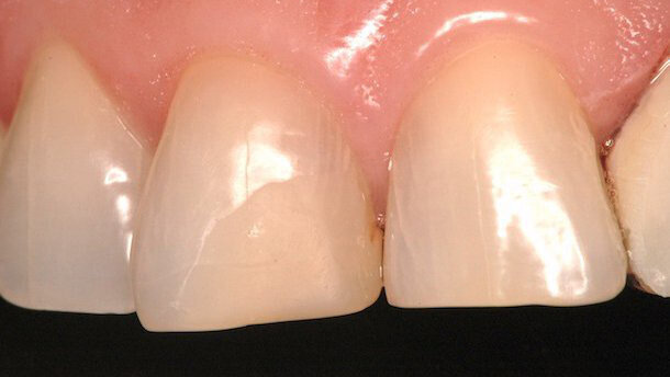 La fluorescencia en restauraciones de resina directa