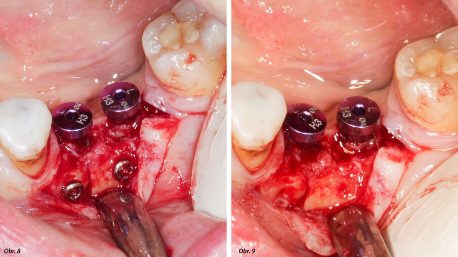 Na implantáty byly umístěny vhojovací válečky.  Osteosyntetické šroubky byly odstraněny.