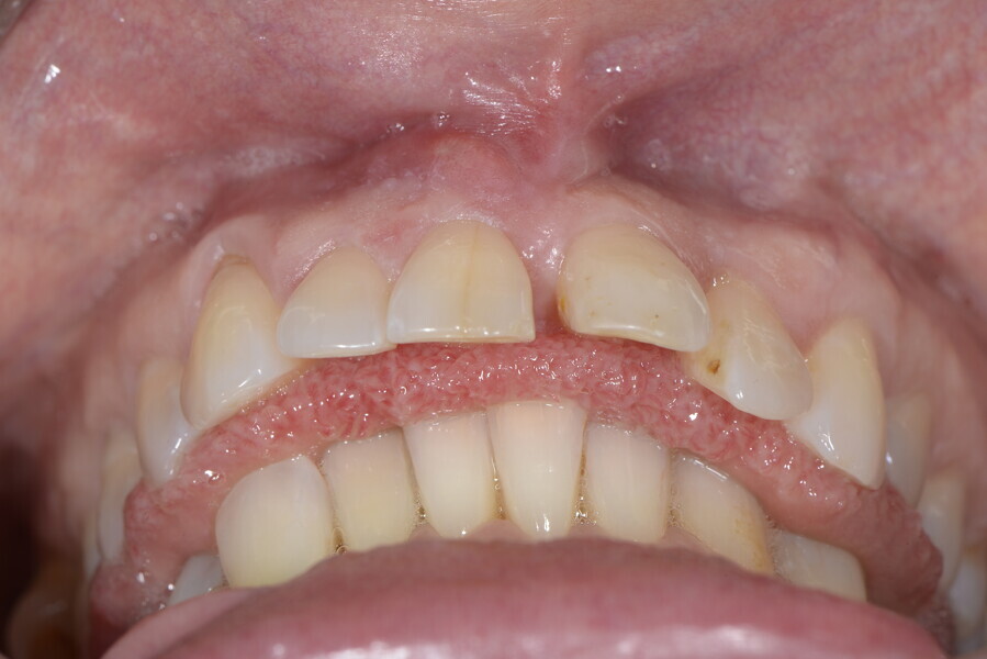 Figs. 5a–c: Deep bite due to lateral tongue interposition at rest and during swallowing, deepening the curve of Spee. During swallowing, the tongue pushed the anterior area forwards, favouring secondary lip interposition.