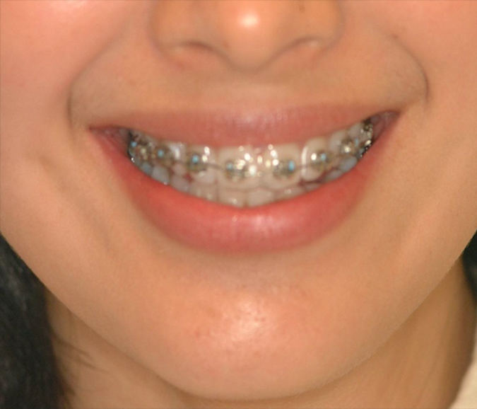 STAGE PROPERTY TREATMENT