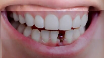 EFP публикува ръководство за превенция и лечение на периимплантните заболявания