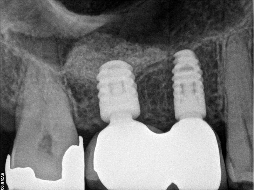 Fig. 24: Post-restoration radiograph.