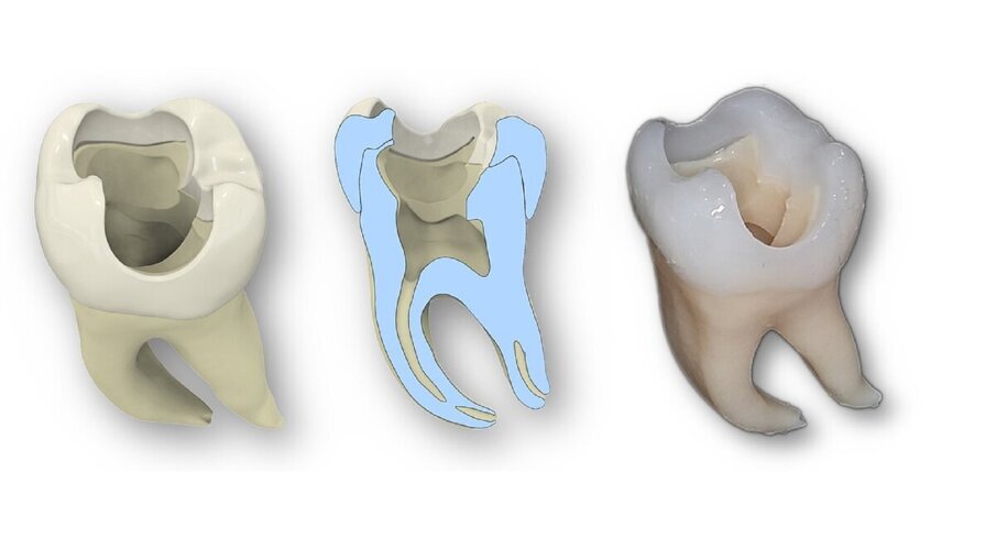 3D-printed teeth improve endodontic training_2