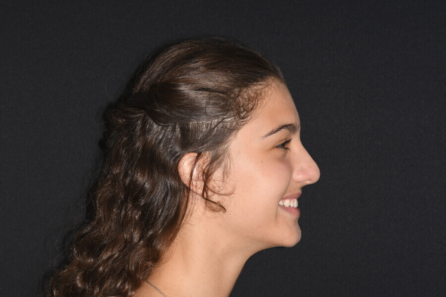 Fig. 15: Final facial photograph. 