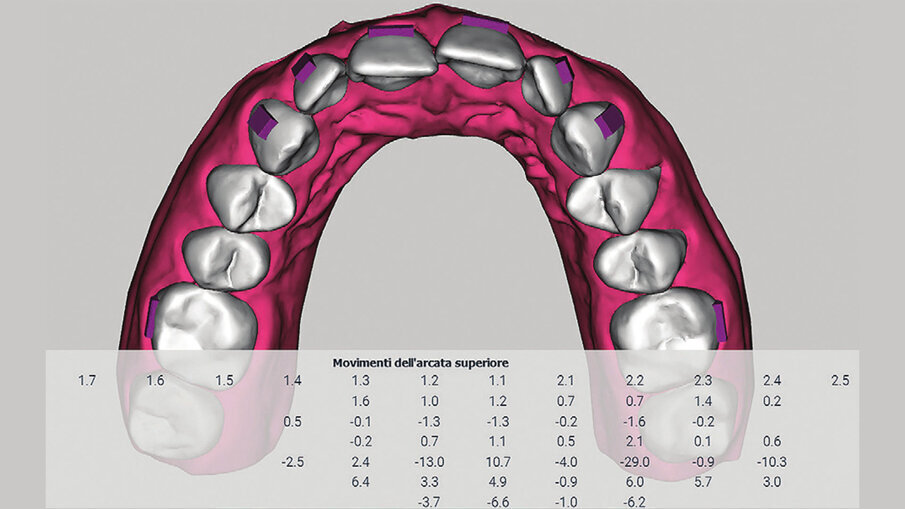 Figg. 5a-5c_View ALLEO ci permette la visualizzazione del set-up, la quantità di stripping necessaria per ottenere un corretto allineamento, la posizione degli attachments, oltre al report biomeccanico preciso di tutti i movimenti dentali proposti all’interno del set-up.
