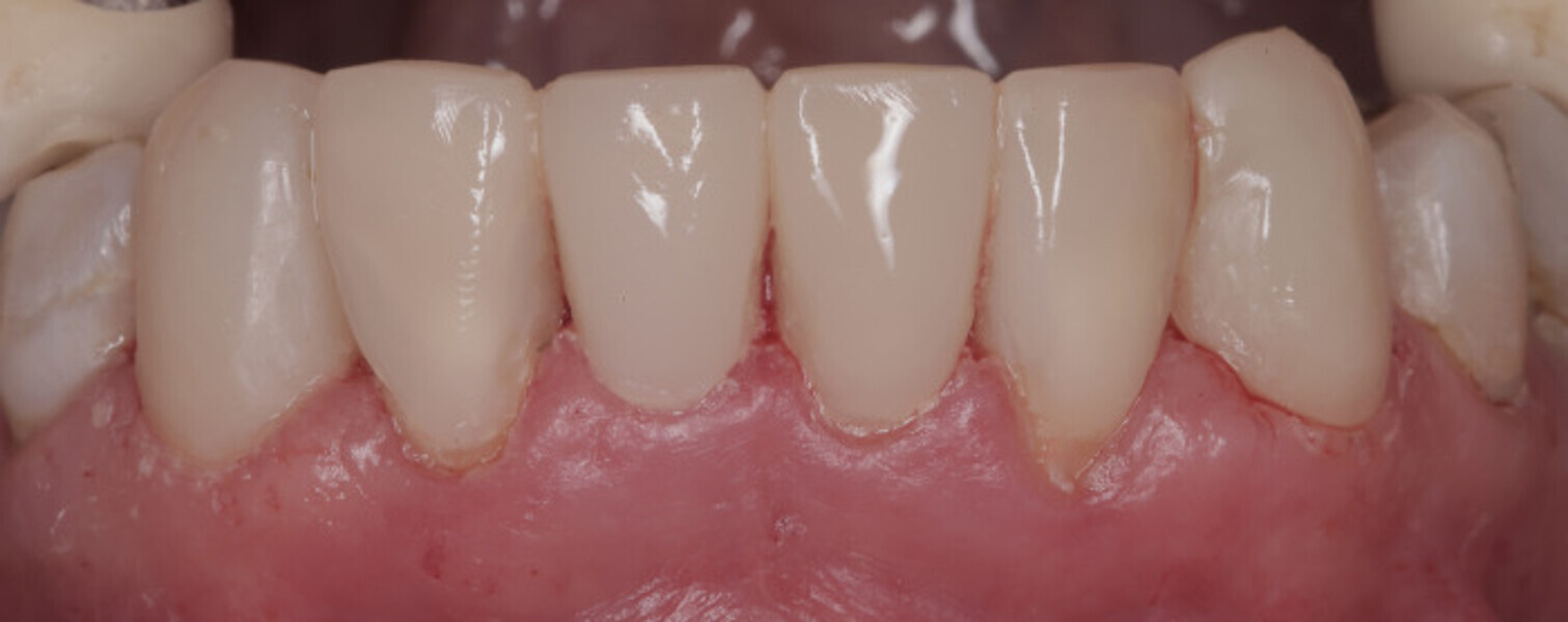 Fig. 4b: Mandibular anterior teeth at initial presentation (a) and after caries removal and injection moulding (b).