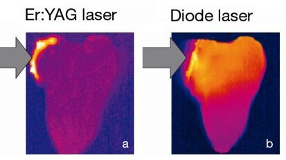 TouchWhite―Next-generation tooth whitening