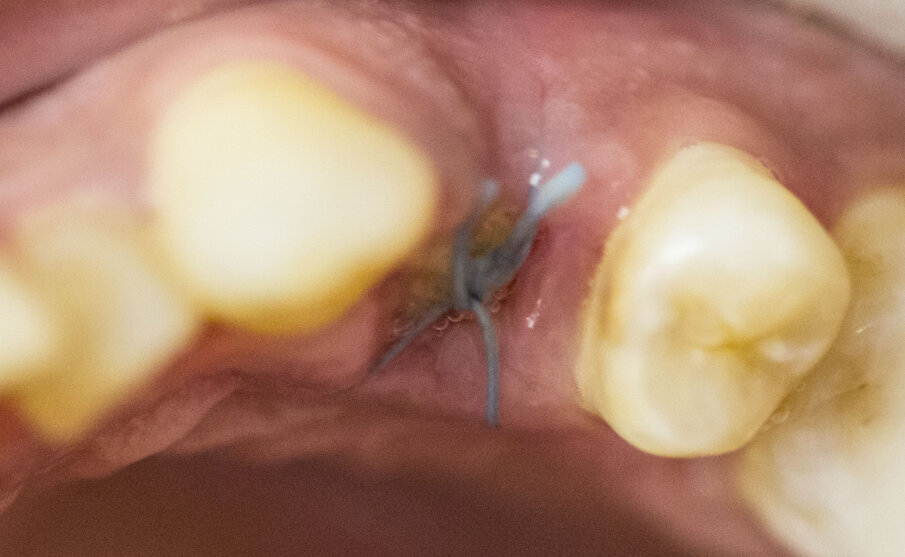 Fig. 9 - Situazione dopo sei giorni.