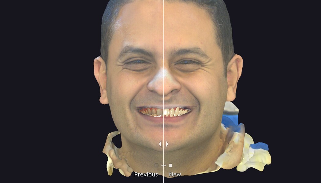 Fig. 6: This split-screen comparison shows the original dentition (left) alongside the proposed digital wax-up. This visual tool supports patient communication and case acceptance.