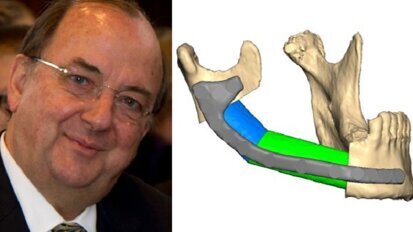 Intervista: alternative al trapianto facciale nella chirurgia orale e maxillofacciale