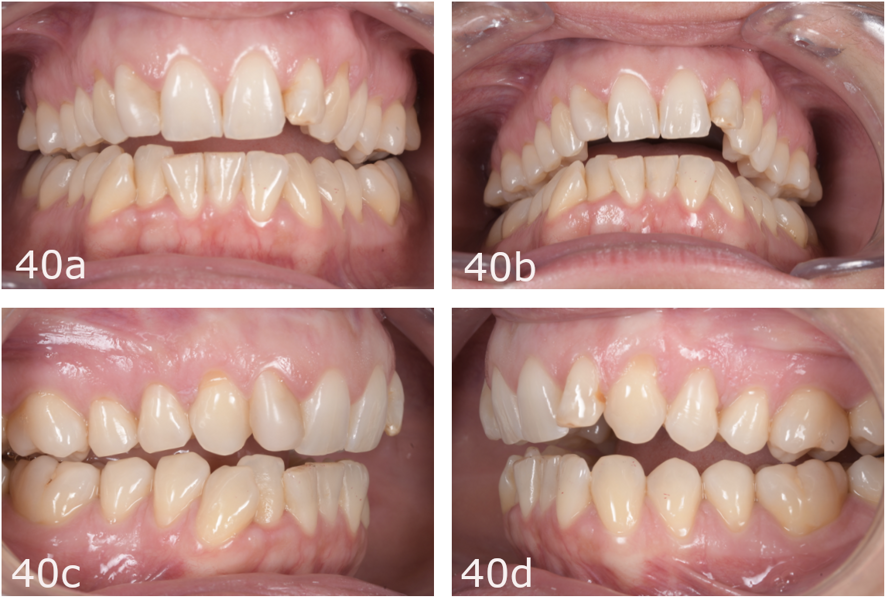 Figs. 40a–d: Occlusion after splint therapy.