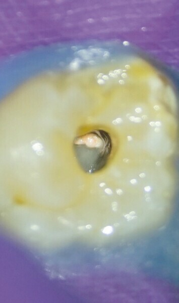 Figs. 8a-c : Entrées des canaux radiculaires obturées et plancher de la cavité pulpaire nettoyé. (a) Vue palatine, (b) vue mésio-vestibulaire et (c) vue disto-vestibulaire. 