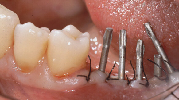 Welded titanium needle implants in treatment of bone atrophy
