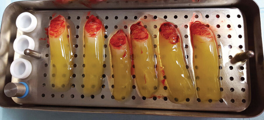 Fig. 3: PRF clots in the PRF box.