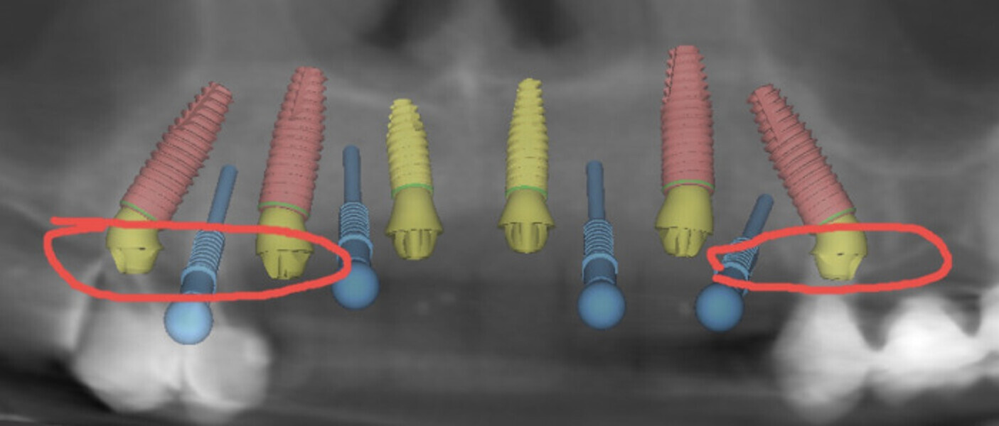 Fig. 10: Planning: angled multi-unit abutments attached to the five stable implants.