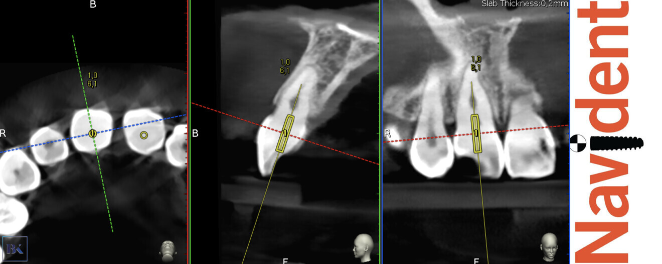 Figs. 16a–c: Planning of the virtual guide for the right incisor. The axis and depth of the preparation are shown.