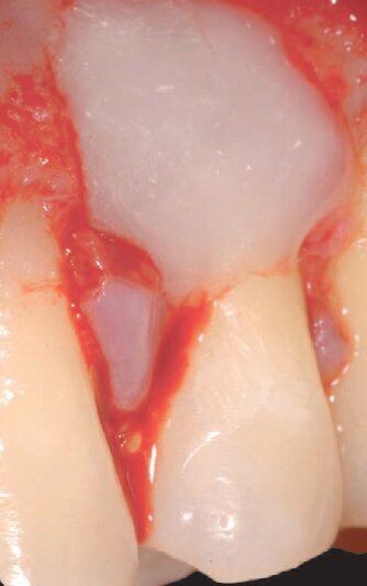 Fig. 6 - Condizionamento della superficie radicolare (EDTA 37%).