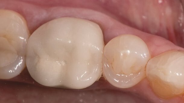 Ceramika – uzasadnienie wyboru materiału