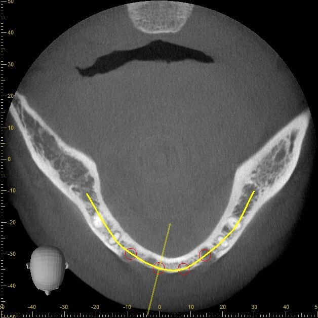 Fig. 3 - Esame CBCT preoperatorio che evidenzia l’anatomia ossea residua.