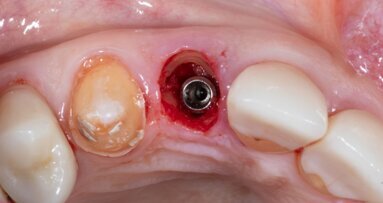 AI uncovers global trends in socket shield technique research