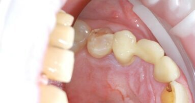 Ceramica ibrida per sollevatori di pesi