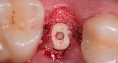 Impianto bifasico in Zirconia – Globale Restauro Metal-Free