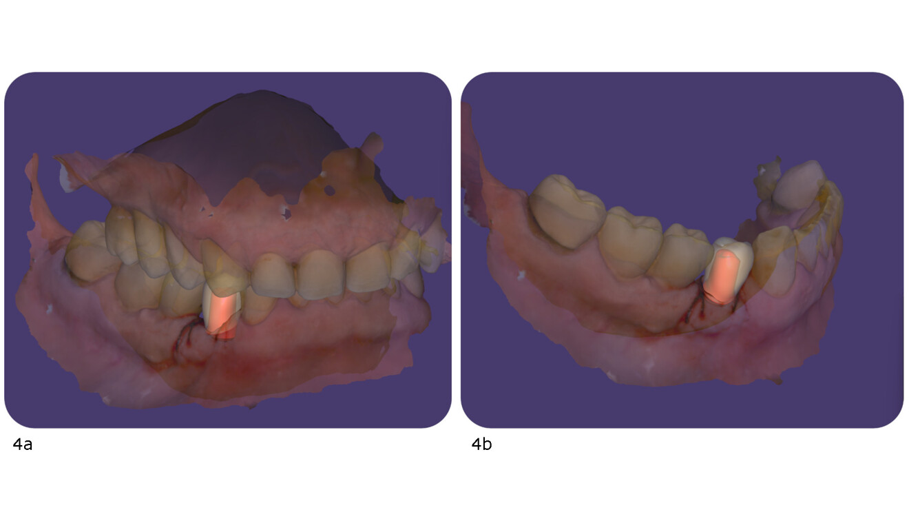 Figs. 4a & b: CAD modelling in DentalCAD of the definitive restoration and of the custom abutment, which was to be milled from titanium, to support the restoration (a & b).