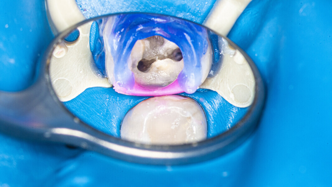Fig. 36: Pulp chamber after the irrigation protocol.