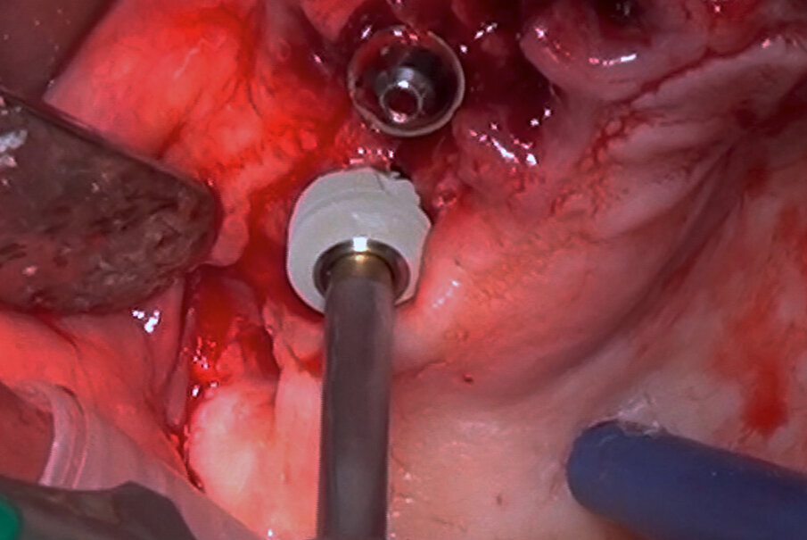 Fig. 5_L’inserimento a livello del mascellare dell’impianto ultra-short.