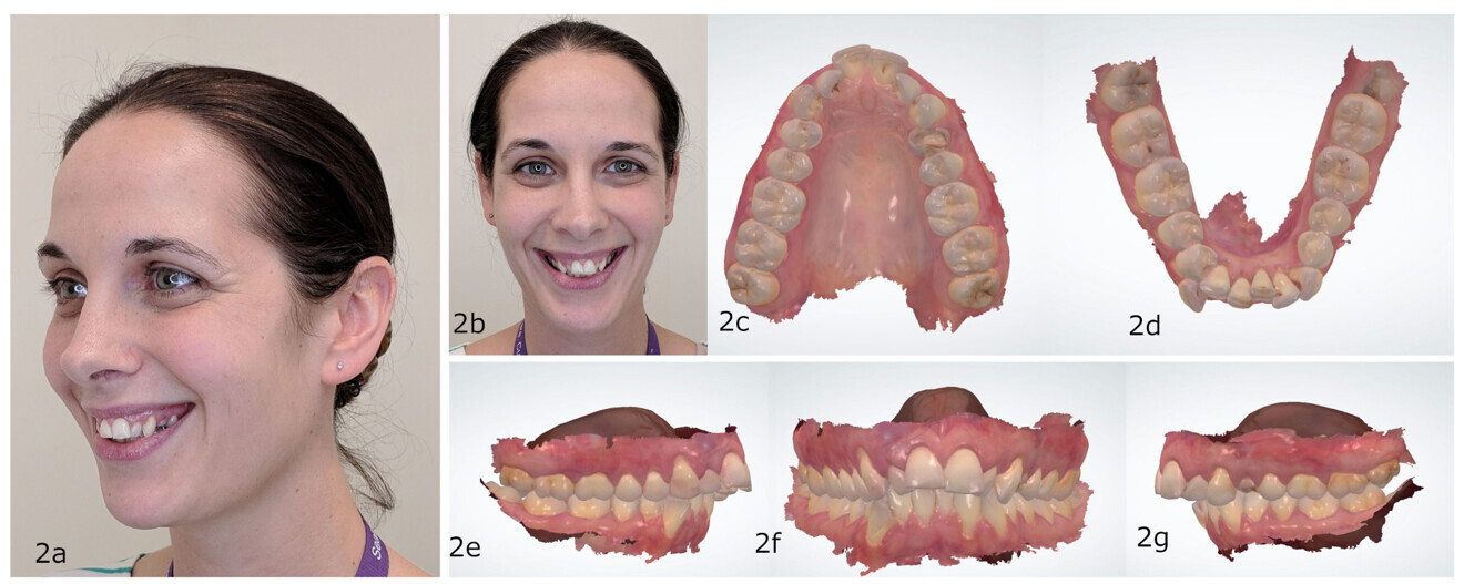 Figs. 2a–g: Illustration of the use of digital treatment simulation to assess the feasibility of extracting the maxillary first premolars and ultimately restoring the maxillary anterior teeth with veneers.