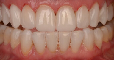 Flowable injection technique—a composite revolution with CLEARFIL MAJESTY ES Flow Low