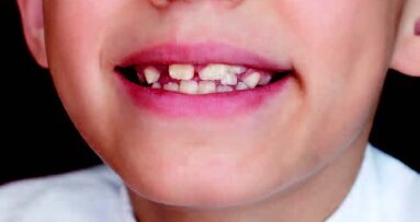 Οι συγκλεισιακές ανωμαλίες επηρεάζουν τη στάση του σώματος και την ισορροπία