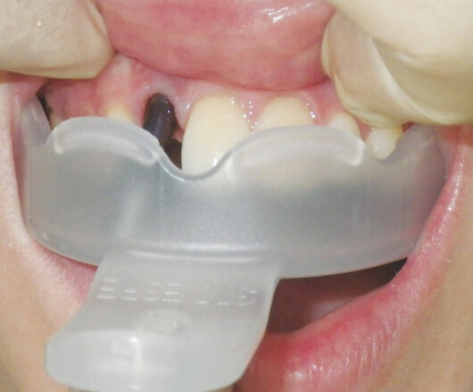Fig. 3: The 3M™ Directed Flow Impression Tray has been chosen for its strength and handling characteristics. Note the palatal reservoir.
