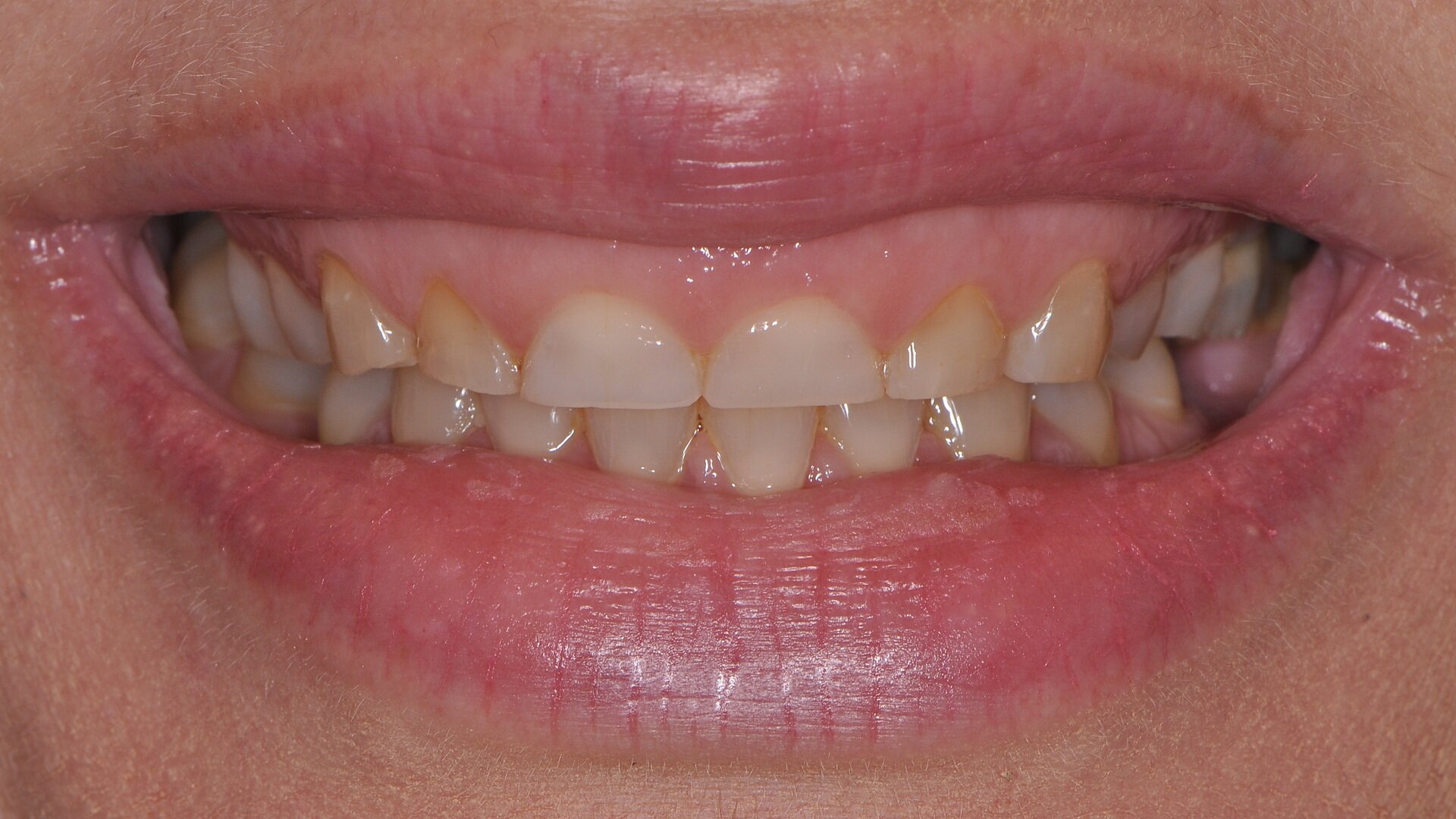 Comprehensive aesthetic transformation: Integrating hard- and soft-tissue treatments using the FotonaSMILE approach