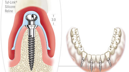 The Atlas Denture Comfort System The Atlas Denture Comfort System