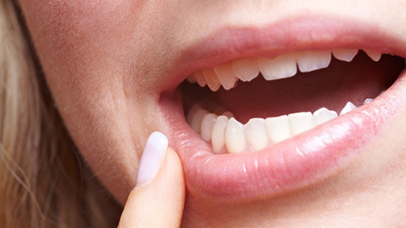 Neue S2k-Leitlinie zum Thema Aphthen veröffentlicht